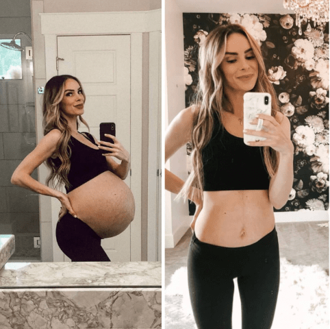 Mommy Makeover: Say Goodbye to Stretch Marks Post-Pregnancy